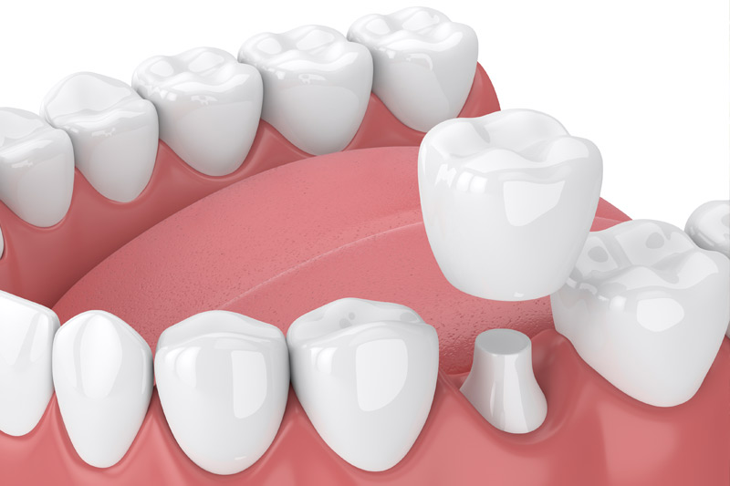 Dental Crowns in Bay City