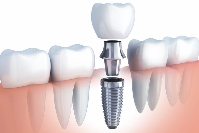 Implants Dentist in Bay City