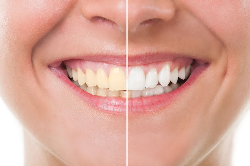 Teeth Whitening in Bay City