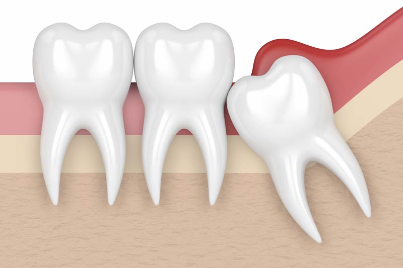 Wisdom Tooth Removal in Bay City